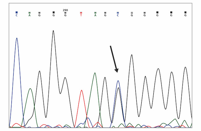 Capillary sequencing chromatogram showing the BRCA1 c.8112C>G variant (marked with the arrow).