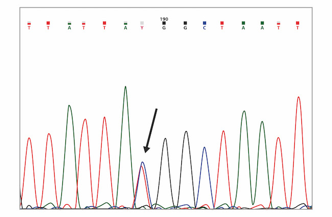 Capillary sequencing chromatogram showing the BRCA1 c.3083G>A (p.Arg1028His) variant (marked with the arrow).
