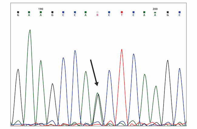 Capillary sequencing chromatogram showing the BRCA1 c.3119G>A (p.Ser1040Asn) variant (marked with the arrow).