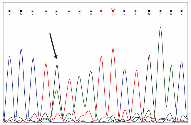 Capillary sequencing chromatogram showing the BRCA2 c.125A>G (p.Tyr42Cys) variant (marked with the arrow).