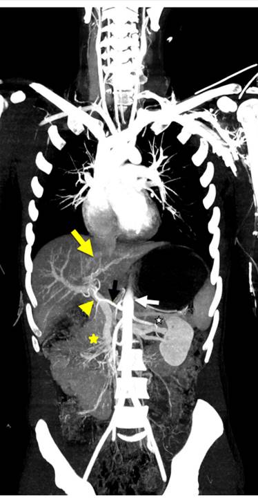 Coronal MIP reconstruction of Single-Pass WBCT. The aorta (White arrow) and hepatic artery (yellow arrow), with higher intensity than portal vein (yellow arrow head), and, median juxtahepatic vein (thick yellow arrow) with the lowest intensity. Also, mesenteric vein and artery (yellow star), and left renal vein and artery (white star) are visualized.