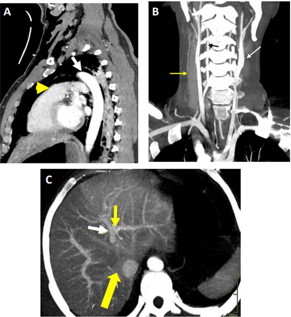 Visualization of solid organ and hollow viscous with Single-Pass WBCT. A) Sagital MIP reconstruction, right and left ventricles, right ventricle outlet tract (thick yellow arrow), left pulmonary vein (thinner right yellow arrow) and aorta (white arrow) are visualized. B) Coronal MIP reconstruction of neck, subclavian arteries, common carotids (white arrow), jugular veins (yellow arrow) and vertebral arteries (black arrow) are observed. C) Axial MIP reconstruction of liver and its vessels, aorta, right yuxtahepatic vein flowing into vena cava (thick yellow arrow), portal left branch (white arrow) and left hepatic artery (upper thin yellow arrow).