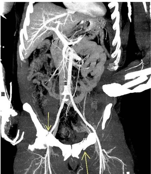 Coronal MIP reconstruction of the pelvis and abdomen. Patient with superior pubic rami fractures (yellow arrows), no associated injuries to adjacent external iliac arteries or veins (white stars).