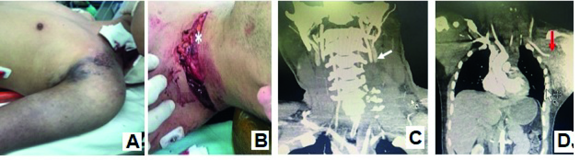 Scapulothoracic dissociation and associated blunt trauma of the vertebral artery. A. Inspection of the patient upon initiating resuscitation B. Identification of the left zone I cervical injury C. CT angiography of the neck, white arrow, thrombosis of segment V2 of the left vertebral artery. D. CT angiography of the neck, abdomen, and chest, red arrow, complete transection of the left axillary artery, increased soft tissue density in the axillary region.