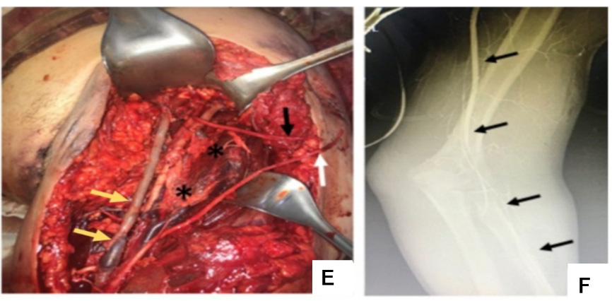 Scapulothoracic dissociation E. Yellow arrow, arterial reconstruction of the axillary vessels. White and black arrow, avulsed secondary trunks of the brachial plexus. F. Intraoperative arteriography with adequate contrast flow to the radial artery after vascular reconstruction.