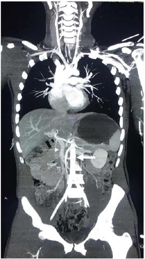 Arterial and venous phases on whole body computed tomography (the bold arrow shows arterial phase and the lighter arrow shows venous phase)