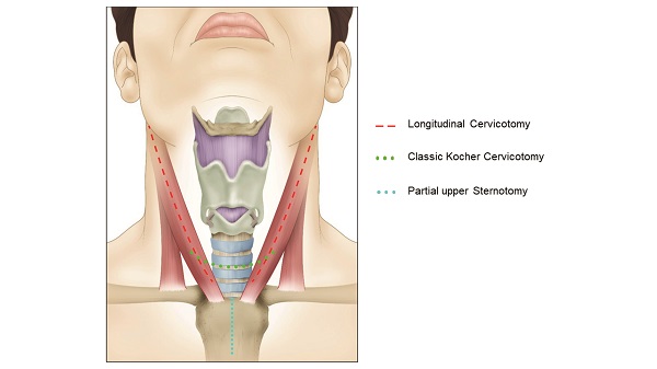 Surgical Approach to the Larynx or Tracheal Injuries. Three incisions can be used for the surgical approach to the laryngotracheal area: 1. Longitudinal Cervicotomy (over the medial border of the sternocleidomastoid muscle (red line)), 2. Transverse Cervicotomy (the Kocher type incision, 3 cm above the sternal manubrium (green line)), and if necessary, a 3. Partial sternotomy (blue line). 