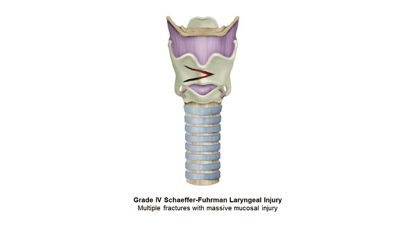 Severe Laryngeal Trauma. Grade IV Shaefer-Furhman Laryngeal Injury. Multiple fractures with massive mucosal injury can be observed.