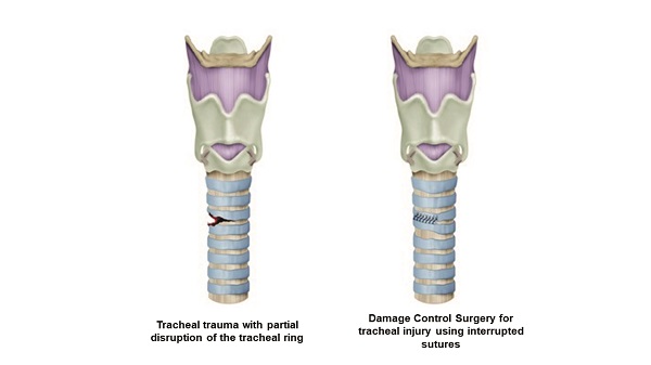 Surgical Management of Tracheal Injuries. For tracheal injuries with partial disruption of the tracheal ring, a primary repair should be performed with absorbable monofilament 3-0 using interrupted sutures.