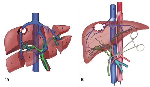 (A) Complex Penetrating Liver Injury; (B) Combined Open and Endovascular Liver Isolation with REBOA, REBOVC and Pringle Maneuver. The open and endovascular liver isolation is achieved performing the REBOA in Zone 1 and REBOVC at the level of the retrohepatic vena cava with the goal of achieving proximal and distal vascular control of a possible retro/suprahepatic vessel injury. The Pringle maneuver is obtained via the hepatoduodenal ligament clamping. 