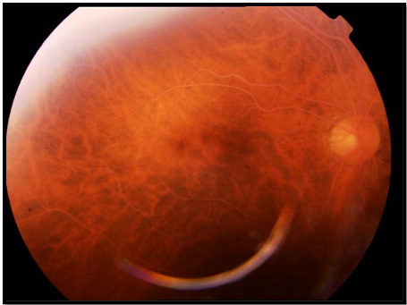 Retinography of the right eye: findings of whitening of all retinal vessels on a salmon-like fundus, compatible with severe lipemia retinalis (Vinger and Sachs Grade III).
