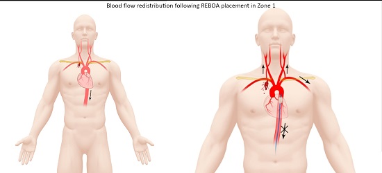 Blood flow redistribution following REBOA placement in Zone 1 