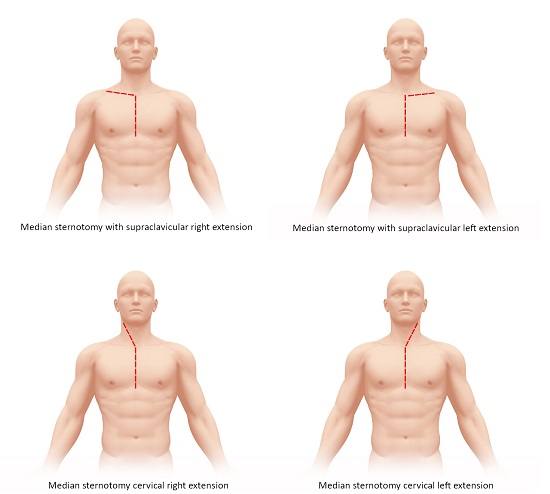 Median Sternotomy with Supra-clavicular Right or Left Extension; 2B. Median Sternotomy with Cervical Right or Left Extension