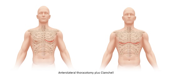 Antero-lateral Thoracotomy plus Clamshell