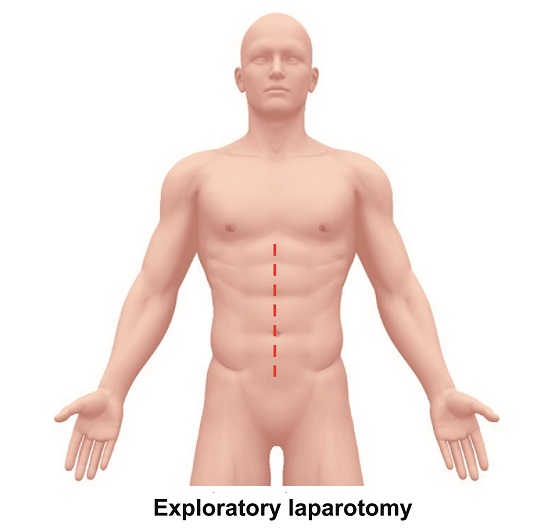 Exploratory Laparotomy