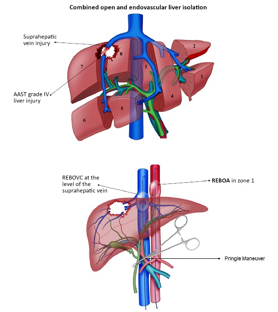 Complex Penetrating Liver Injury AAST Grade III-V; 5B. Combined Open and Endovascular Liver Isolation with Pringle Maneuver, REBOA (resuscitative endovascular balloon occlusion of the aorta) and REBOVC (Resuscitative balloon occlusion of the inferior vena cava)