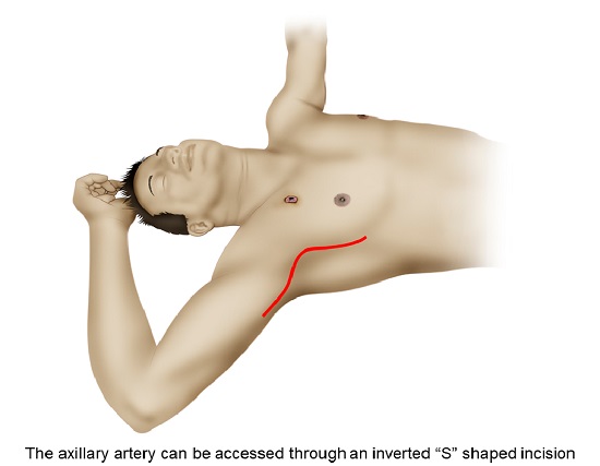 Surgical approach to the axillary artery. The axillary artery can be accessed through an inverted &ldquo;S&rdquo; shaped incision starting at the pectoralis major muscle, curving in the axillary fossa and ending in the arm between the bicep and tricep muscles. This incision prevents future scar retraction and functional limitation of the shoulder joint.