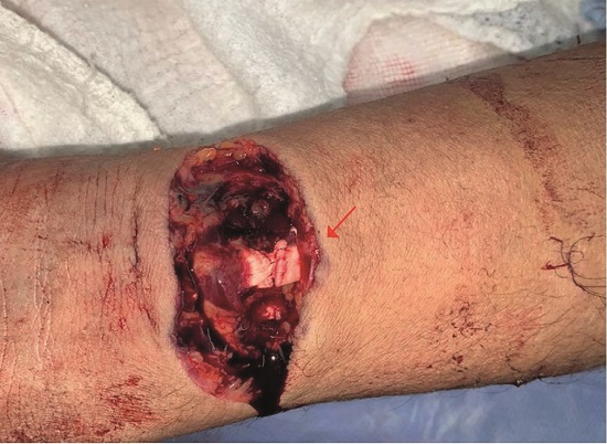 33-year-old male. Wound in the distal third of the left forearm (red arrow) with a complete section of radial and ulnar arteries.
