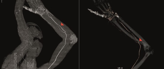 33-year-old male. A complete section of radial and ulnar arteries. A. The red arrow indicates the median artery. B. The red arrow indicates the origin of the median artery as a continuation of the anterior interosseous artery. Angiotomography. Ioversol injection. 100 mL. 3 seconds.