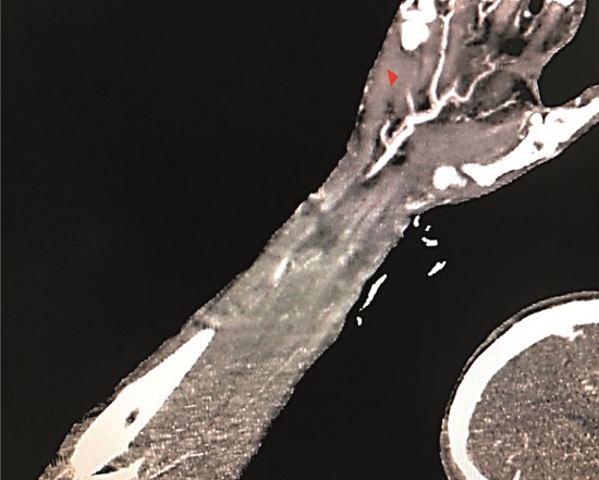 33-year-old male. A complete section of radial and ulnar arteries. The red arrow indicates the incomplete superficial palmar arch by the median artery. Angiotomography. Ioversol injection. 100 mL. 3 seconds.