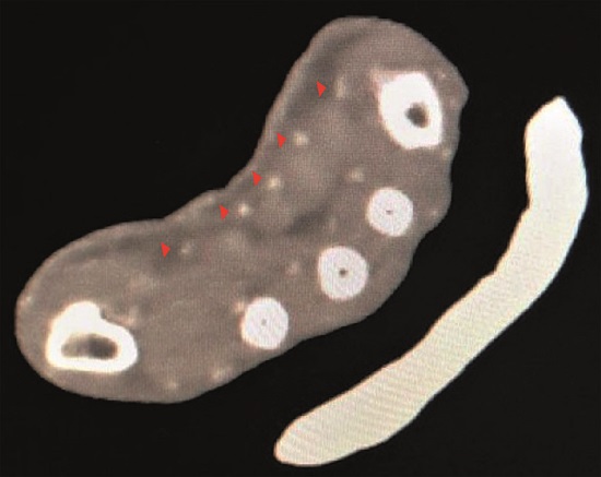 33-year-old male. A complete section of radial and ulnar arteries. Red arrows are indicating the adequate perfusion of the hand. Angiotomography. Ioversol injection. 100 mL. 3 seconds.
