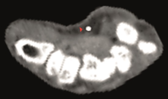 33-year-old male. A complete section of radial and ulnar arteries. The red arrow indicates the median artery at the carpal level. The diameter of the persistent median artery at this level was 2.5 mm. Angiotomography. Ioversol injection. 100 mL. 3 seconds.