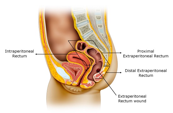 Anatomical Division of the Rectum: Intraperitoneal and Extraperitoneal Portions. An extraperitoneal rectal injury involving less than 25% of the circumference (nondestructive) is shown. 
