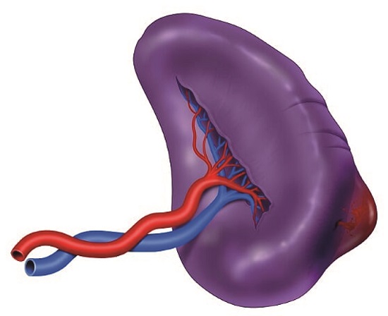AAST Grade II Splenic Injury. Subcapsular splenic hematoma. These injuries require an early splenic packing. Once bleeding has been controlled, damage control surgery should be completed and the subsequent need for angiography with embolization should be assessed.