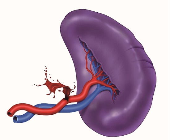 AAST Grade V Splenic Injury. Splenic artery involvement. Splenic injuries with complete destruction and/or devascularization require a splenectomy for hemorrhage control followed by damage control surgery. 