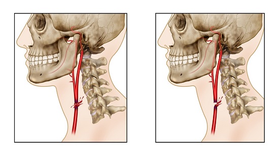 Common Carotid Artery Injury. A. Proximal and distal flow present. B. Proximal flow but no reflux flow from the distal end.