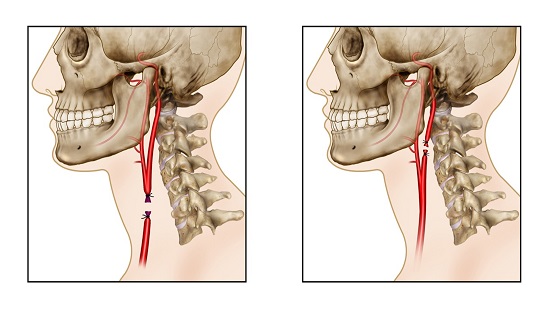 Carotid Artery Ligation. A. Common carotid artery ligation. B. Internal carotid artery ligation.