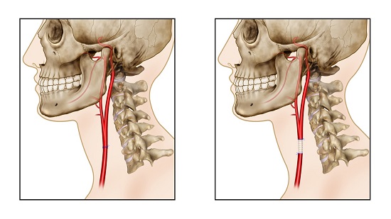 Open Surgical Repair of the Common Carotid Artery . A. Common carotid artery anastomosis. B. PTFE interposition graft.