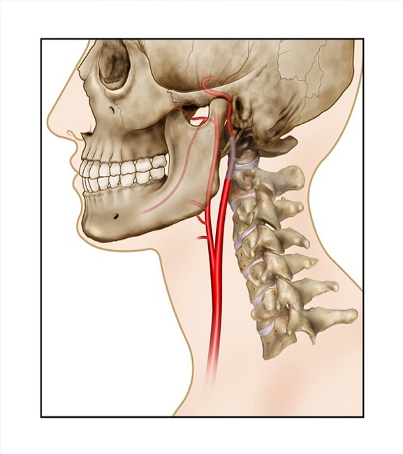 Endovascular Repair of the Internal Carotid Artery. A. Endovascular Stent placement. 