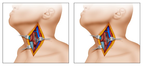 Surgical approach to a cervical esophageal injury. A. The patient's head should be turned towards the right, exposing the anterior triangle of the neck. A left longitudinal incision should follow from the earlobe crease and extending to the sternal notch following the anterior border of the left sternocleidomastoid muscle. B. Primary suture repair is made by using 3-0 PDS absorbable suture as separate transfixing stitches in a single plane. Do not leave any perilesional drainage.