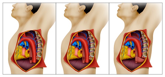 Surgical approach to an inferior thoracic esophageal injury. A. Inferior thoracic esophageal injury. These injuries should be accessed via a left fourth or fifth intercostal posterolateral thoracotomy. B. Primary suture repair is made by using 3-0 PDS absorbable sutures as separate stitches in a single plane. C. The repair should be reinforced with a viable and well-perfused intercostal muscle patch. Finally, a chest tube should be placed and, if possible, the incision should be closed by planes.