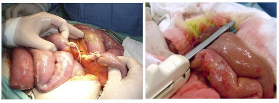 Deferred Intestinal Anastomosis. A. Small bowel injury is left in discontinuity as damage control surgery. B. Intestinal reconstruction via deferred small bowel anastomosis using stapple technique. 