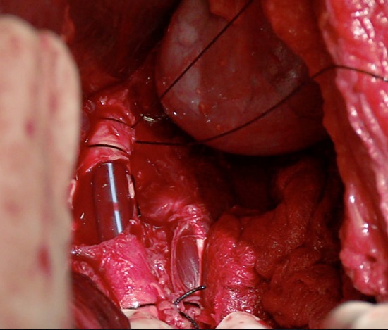 Vascular Shunt on Aorta artery. Infrarenal aorta injury is temporally treated using a vascular shunt 