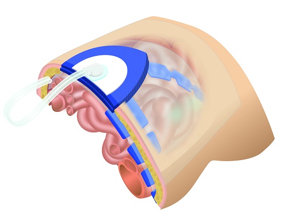 Negative Pressure Wound Therapy to deferred closure of the abdomen. A fenestrated plastic separates intra-abdominal organs, while foam sponges or dressings are placed over it and secured beneath a double layer of adhesive sheets. The suction device is installed over the adhesive film by cutting out a 3 to 3.5 cm diameter circle