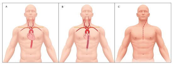 Left Carotid Artery Injury Management. A. Proximal Left Carotid Artery Injury. B. Proximal Left Carotid Artery Injury with REBOA in Zone 1. C. Median Sternotomy with Left Cervical Extension. 