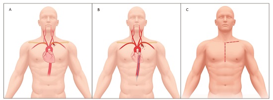 Proximal Left Subclavian Artery Injury Management. A. Proximal Left Subclavian Artery Injury. B. Proximal Left Subclavian Artery Injury with REBOA in Zone 1. C. Median Sternotomy with Supraclavicular Extension. 