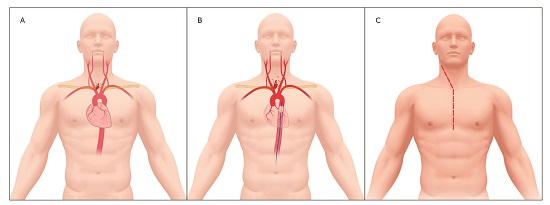 Innominate/Brachiocephalic Artery Injury Management. A. Innominate/Brachiocephalic Artery Injury. B. Innominate/Brachiocephalic Artery Injury with REBOA in Zone 1. C. Median Sternotomy with Right Cervical Extension 