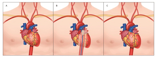 Proximal Pulmonary Artery Injury Management. A. Proximal Pulmonary Artery Injury. B. Proximal Pulmonary Artery Injury with REBOA in Zone 1. C. Primary Repair via Median Sternotomy 