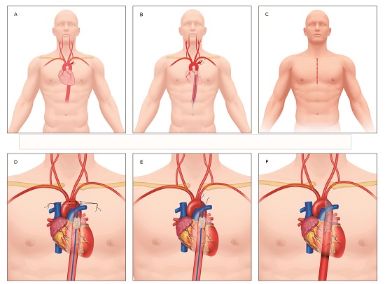 Descending Aortic Injury Management. A. Descending Aortic Injury. B. Descending Aortic Injury with REBOA in Zone 1. C. Median Sternotomy should be performed. D. Parallel Sutures Criss-Crossed. E. Primary Repair with REBOA in Zone 1. F. Primary Repair Plus Endostent Reinforcement. 
