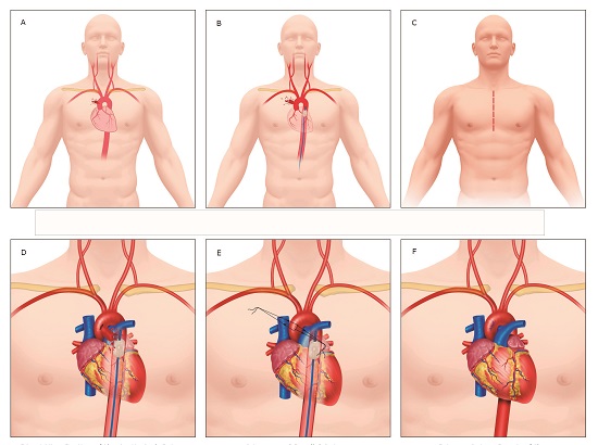 Aortic Arch Injury Management. A. Aortic Arch Injury. B. Aortic Arch Injury with REBOA in Zone 1. C. Median Sternotomy. D. Parallel Sutures Criss-Crossed. E. Primary Repair.