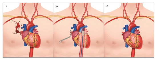 Pulmonary Hilum Injury Management. A. Pulmonary Hilum Injury. B. Control with Satinsky Clamp and REBOA in Zone 1. C. Pulmonary Hilum Ligation