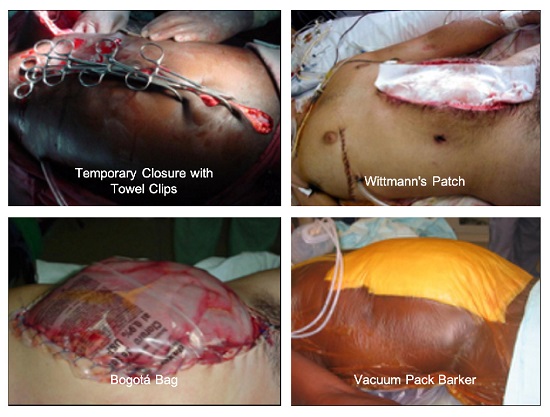 Temporary abdominal wall closure techniques. (A) Temporal Closure with Towel Clips, (B) Wittmann&rsquo;s Patch, (C) Bogot&aacute; Bag, (D) Vacuum Pack Barker. 