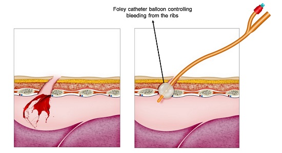 Hemostatic effect over the thoracic wall using a Foley catheter. To control persisting surgical bleeding from thoracic wall bone structures (vertebral bodies, ribs, or sternum), a Foley catheter should be inserted directly into the bone wound, then inflated and gently retracted until hemorrhage control is achieved. 