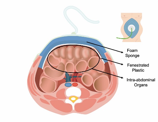 Negative pressure dressing with a fenestrated plastic interface. A plastic with linear perforations not longer than 5 mm should be extended over the entire cavity covering the recesses completely and separating intra-abdominal organs from the abdominal wall.