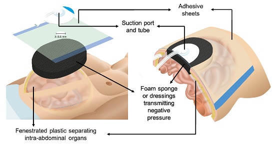 Negative pressure dressing system placement. A fenestrated plastic separates intra-abdominal organs, while foam sponges or dressings are placed over it and secured beneath a double layer of adhesive sheets. The suction device is installed over the adhesive film by cutting out a 3 to 3.5 cm diameter circle. 