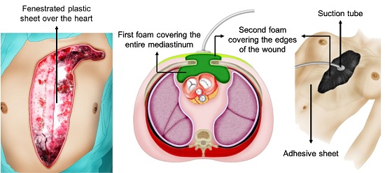 Negative Pressure Dressing Placement Following Sternotomy Approach. A fenestrated plastic sheet is placed over the heart, followed by a first foam that covers the entire mediastinum and a second foam covering the two edges of the sternotomy and the space between them. The system is sealed with an adhesive sheet, which is connected to the suction tube by a hole cut in the adhesive film. 